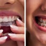 Enhancing Smiles with Invisalign Treatments