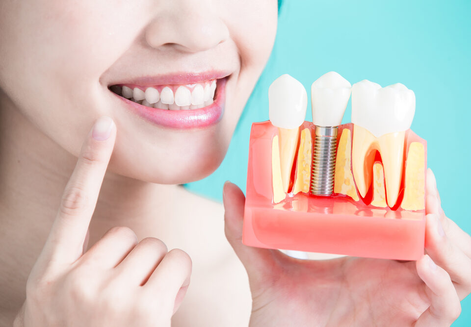 Innovative Dental Implants for Confident, Healthy Smiles