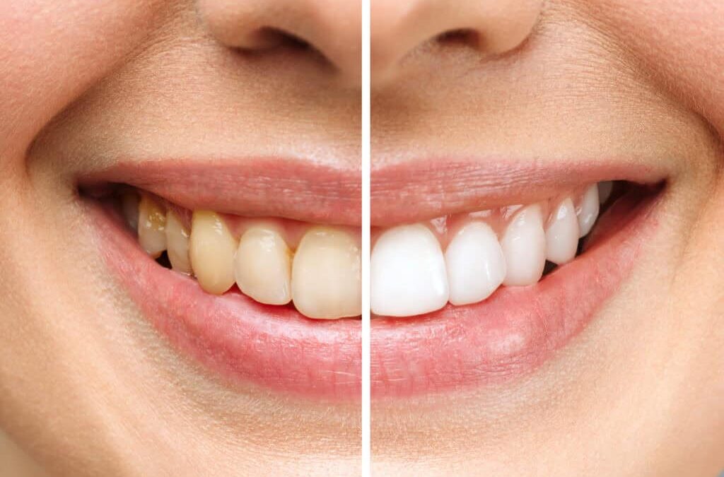 The Role of Teeth Whitening in Enhancing Your Smile