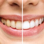 The Role of Teeth Whitening in Enhancing Your Smile