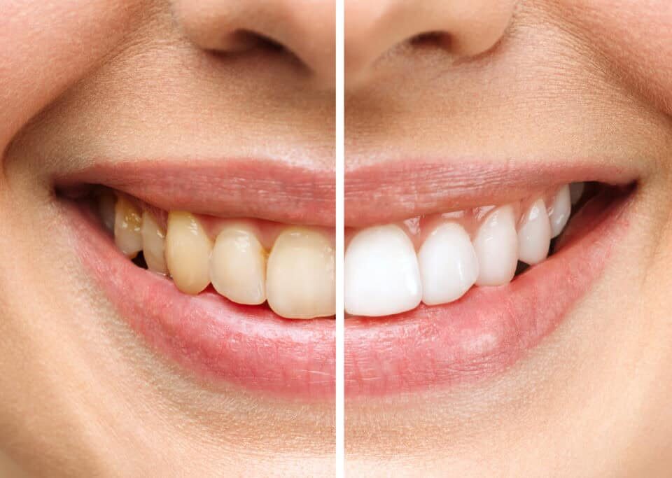 The Role of Teeth Whitening in Enhancing Your Smile