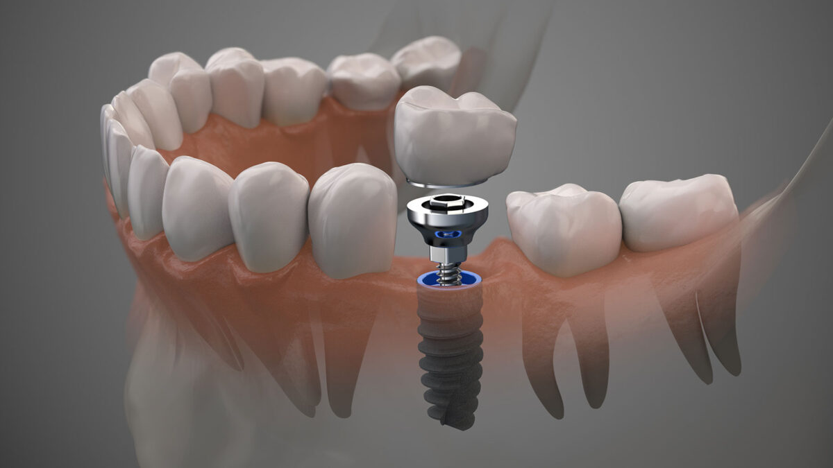Understanding the Longevity and Care of Dental Implants