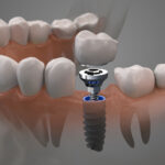 Understanding the Longevity and Care of Dental Implants