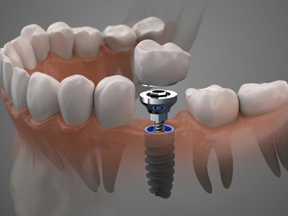 Understanding the Longevity and Care of Dental Implants